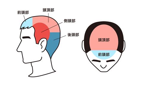 頭頂頭痛 原因|頭頂部の頭痛に関連する5つの病気